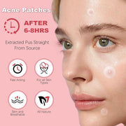 72 Counts Pimple Patches for Face Hydrocolloid Acne Patches for Face Invisible Zit Patches for Face Pimple Patch Acne Spot Patch Blemish Patches Cover Patches Stickers