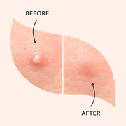 Magical Patch Hydrocolloid Pimple Patches – 36 Count