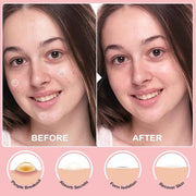 72 Counts Pimple Patches for Face Hydrocolloid Acne Patches for Face Invisible Zit Patches for Face Pimple Patch Acne Spot Patch Blemish Patches Cover Patches Stickers